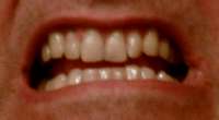 Behandlungsfehler Zähne